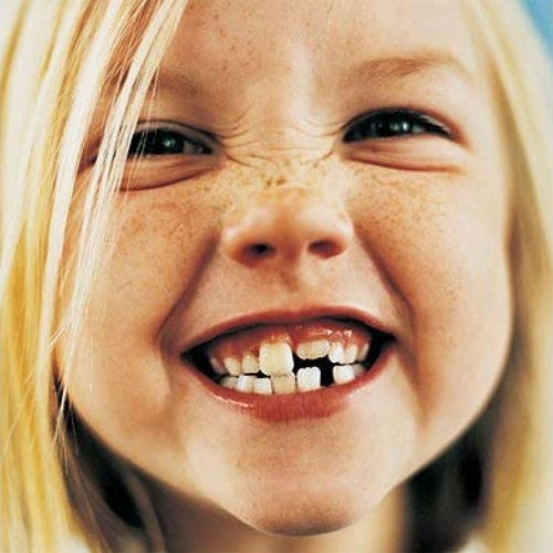 ¿Qué es la caries interdental y cómo te afecta?