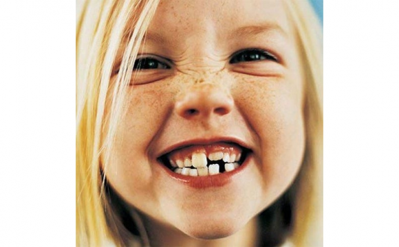 ¿Qué es la caries interdental y cómo te afecta?