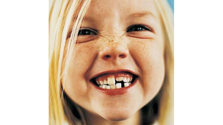 ¿Qué es la caries interdental y cómo te afecta? ¿Qué es la caries interdental y cómo te afecta?